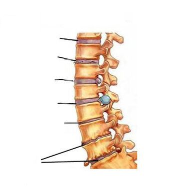 Conas a fhorbraíonn osteochondrosis