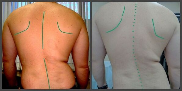 Cuaire an dromlaigh le osteochondrosis