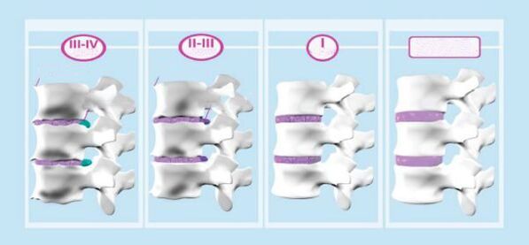 Céimeanna Osteochondrosis Ceirbheacs