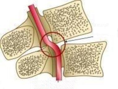 Siondróm artaire Vail