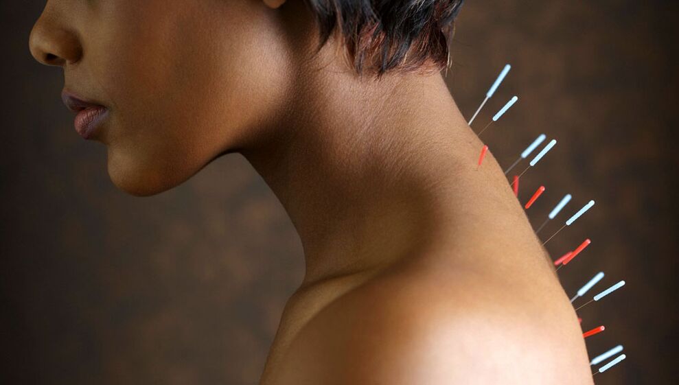 acupuncture le osteochondrosis ceirbheacs