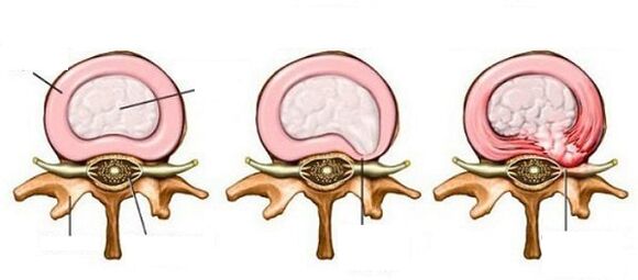 hernia intervertebral le osteochondrosis ceirbheacs