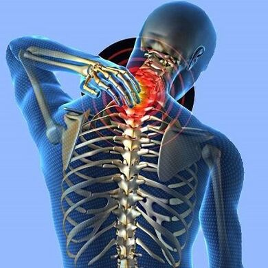 pian muineál le osteochondrosis ceirbheacs