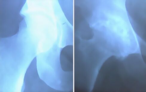 Scum de airtrosis de chomhpháirt na glúine