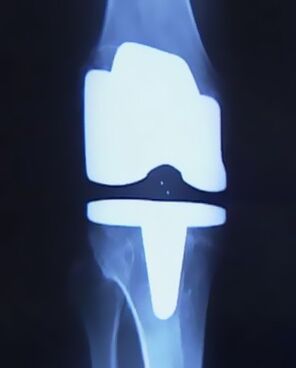 X -Pictiúr de na glúine le próistéis shaorga tar éis na hoibríochta chun an chomhpháirt a athrú