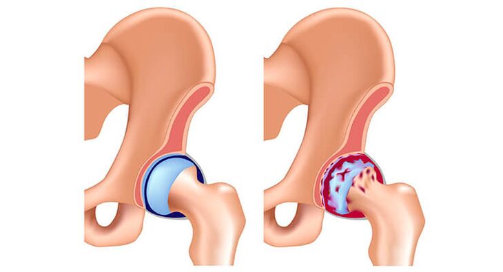 sláintiúil agus arthrosis-tionchar comhpháirteach cromáin