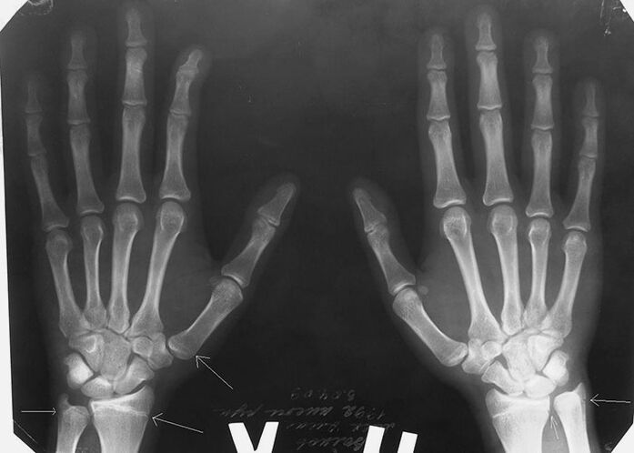 X-gha le haghaidh pian i joints na méara