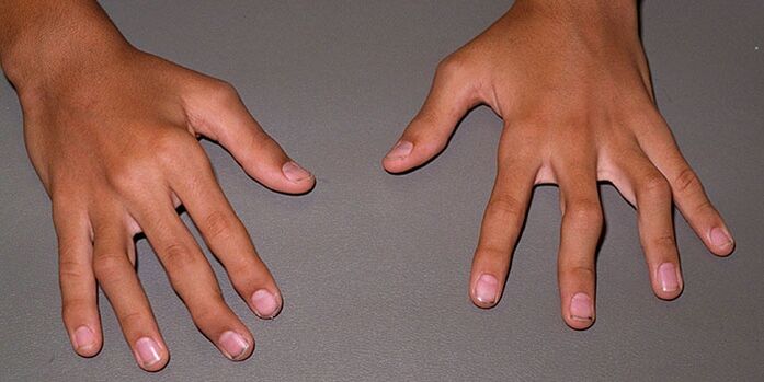 joints finger gortaithe