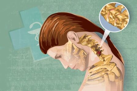 Comharthaí athfhillteach osteochondrosis